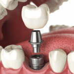 Teeth Implants Abroad