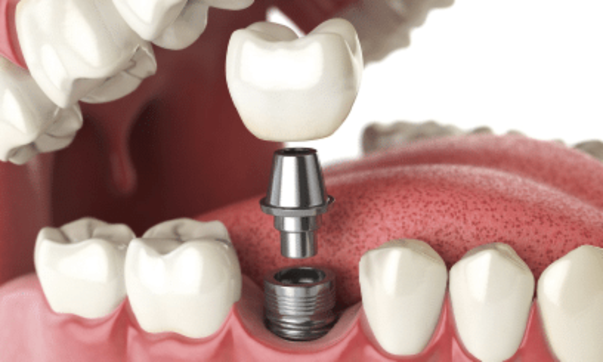 Teeth Implants Abroad